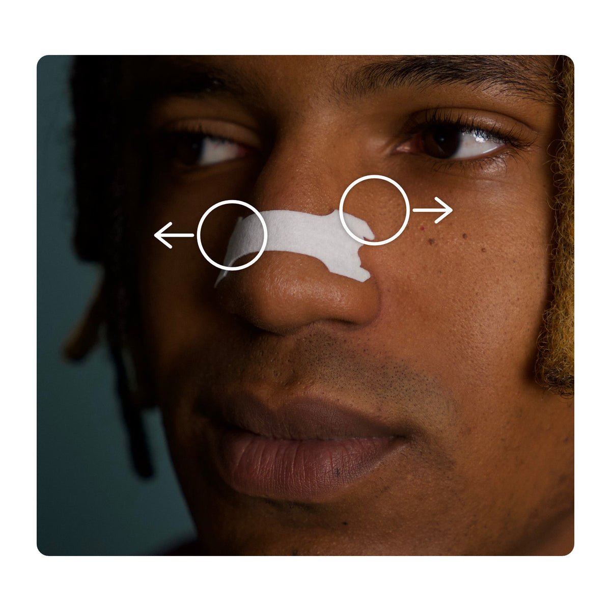 Real close-up of the white Minty strip on a nose; circles mark both ends, which gently lift the sides of the nose from the outside.